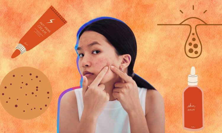 Adult Acne-How Do You Get Rid of It Sisterhood Agenda